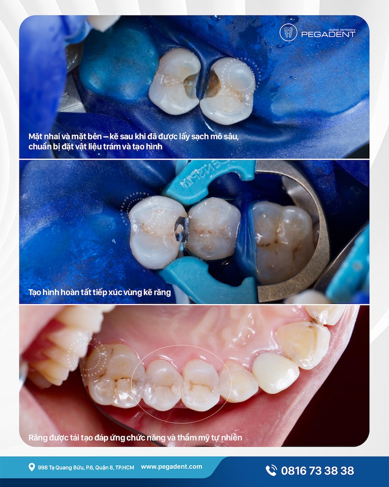 Trám răng chữa sâu răng quận 8 - Nha khoa Pegadent